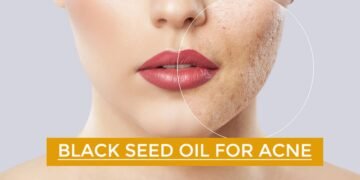 Black Seed Oil for Acne