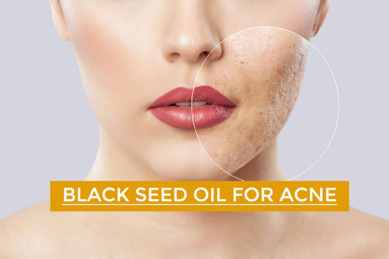 Black Seed Oil for Acne