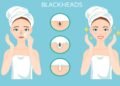 Essential Oils for Blackheads