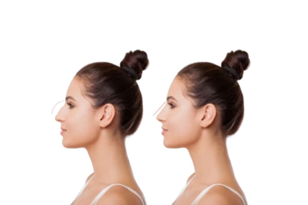 Rhinoplasty Surgeons in Sydney