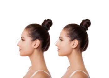 Rhinoplasty Surgeons in Sydney