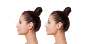 Rhinoplasty Surgeons in Sydney