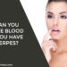 Can You Give Blood If You Have Herpes