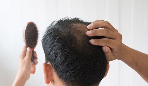 Choosing Hair Transplantation