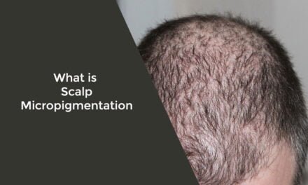 What is Scalp Micropigmentation
