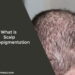 What is Scalp Micropigmentation