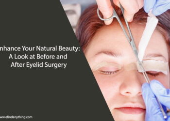 Before and After Eyelid Surgery