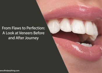 Veneers Before and After