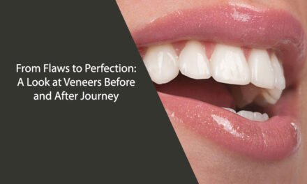From Flaws to Perfection: A Look at Veneers Before and After Journey