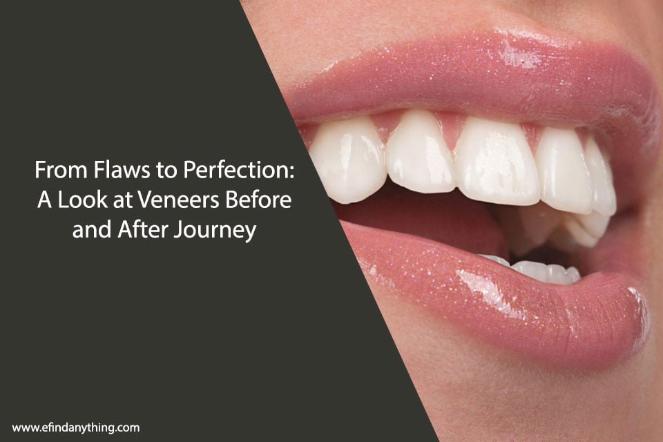 Veneers Before and After