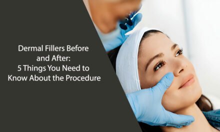 Dermal Fillers Before and After: 5 Things You Need to Know About the Procedure