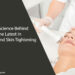 Ultrasound Skin Tightening