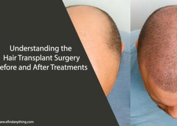 Hair Transplant Surgery Before and After