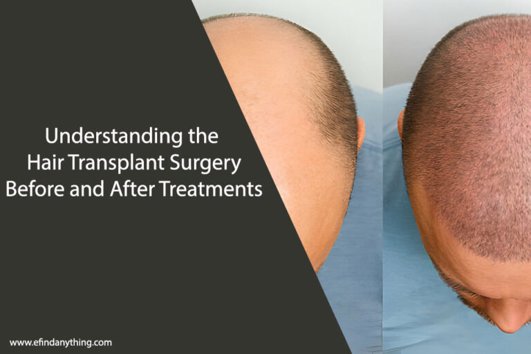 Hair Transplant Surgery Before and After