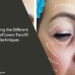 Lower Facelift Techniques