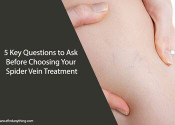 5 Key Questions to Ask Before Choosing Your Spider Vein Treatment