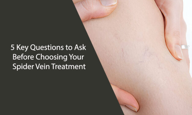 5 Key Questions to Ask Before Choosing Your Spider Vein Treatment