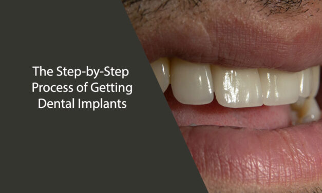 The Step-by-Step Process of Getting Dental Implants