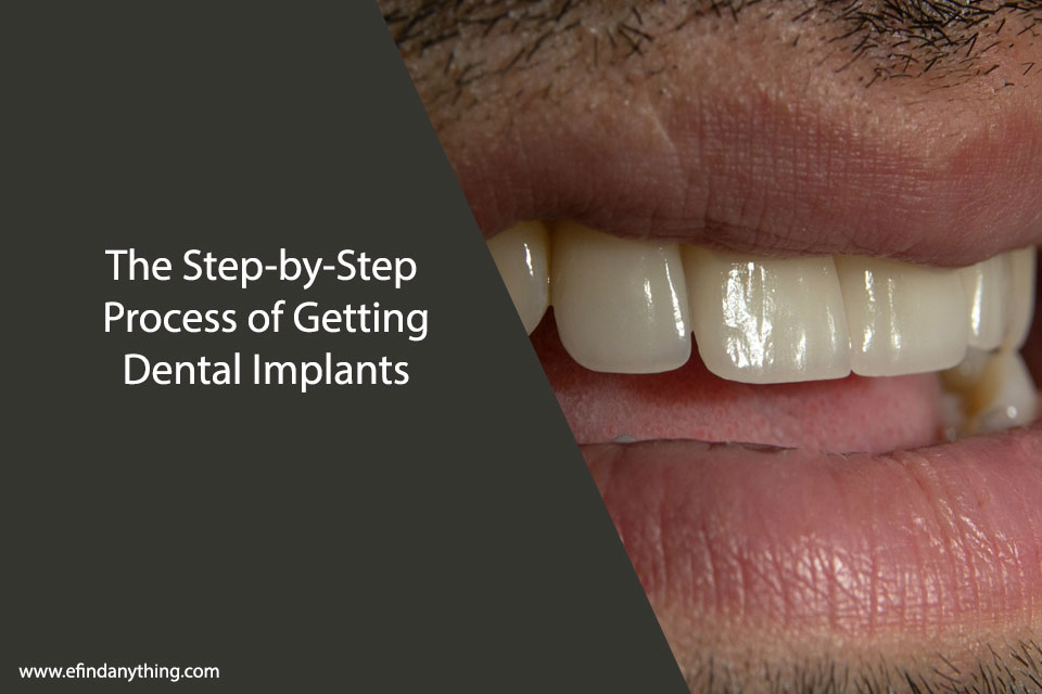 Dental Implants
