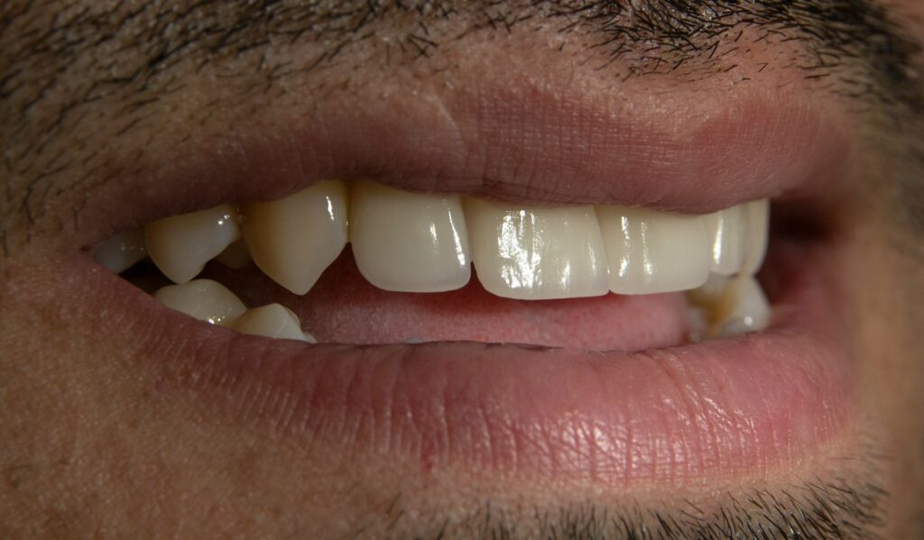 The Step-by-Step Process of Getting Dental Implants