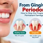 Gingivitis progressing to periodontitis with gum inflammation and bone loss